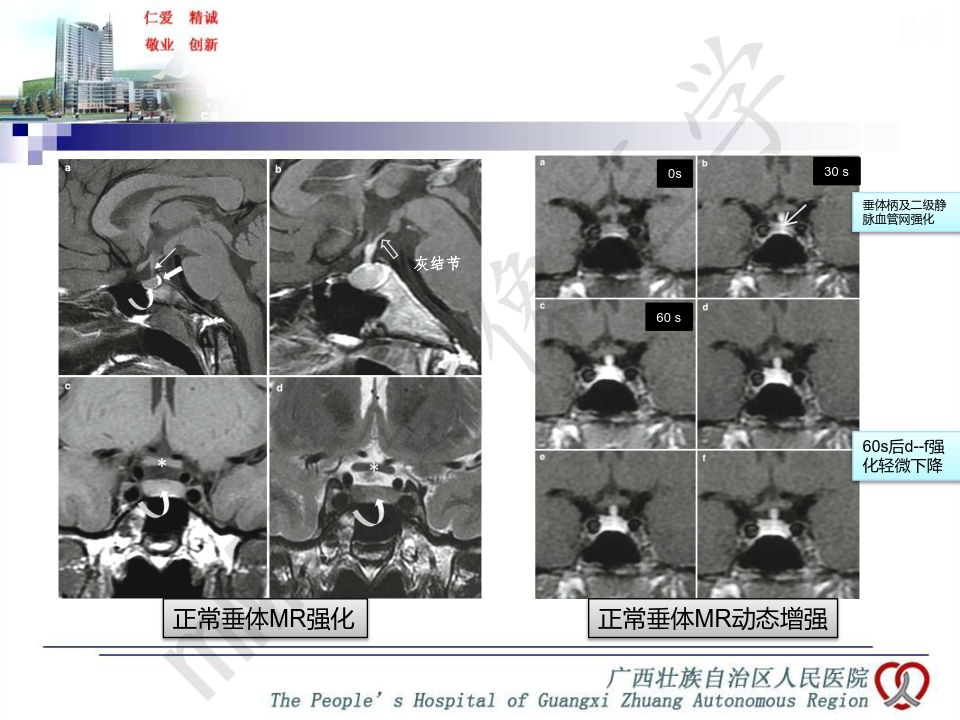 【PPT】垂体非肿瘤性病变MR诊断
