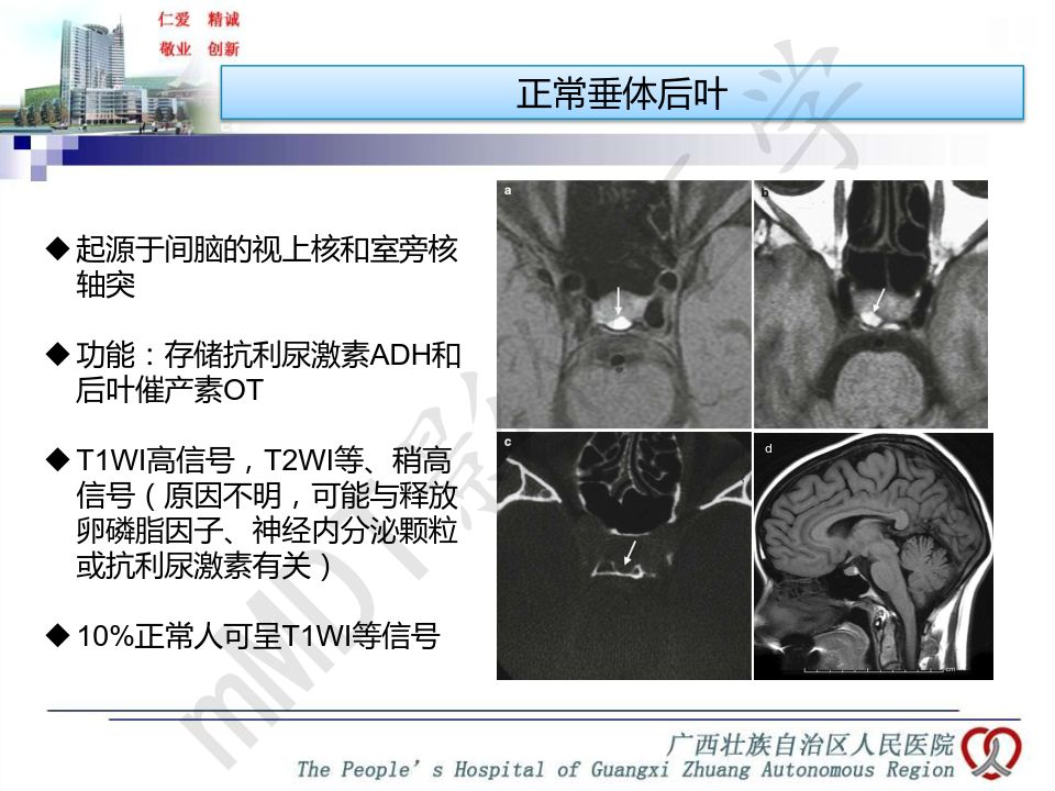 【PPT】垂体非肿瘤性病变MR诊断