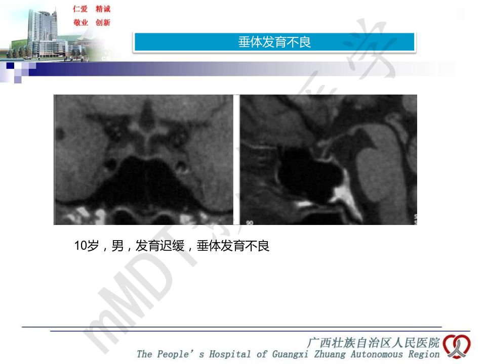 【PPT】垂体非肿瘤性病变MR诊断