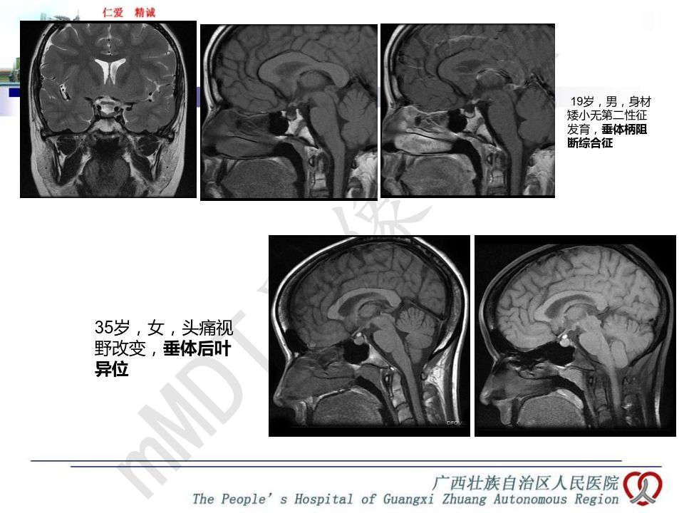 【PPT】垂体非肿瘤性病变MR诊断