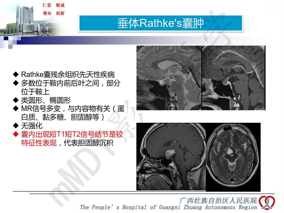 【PPT】垂体非肿瘤性病变MR诊断