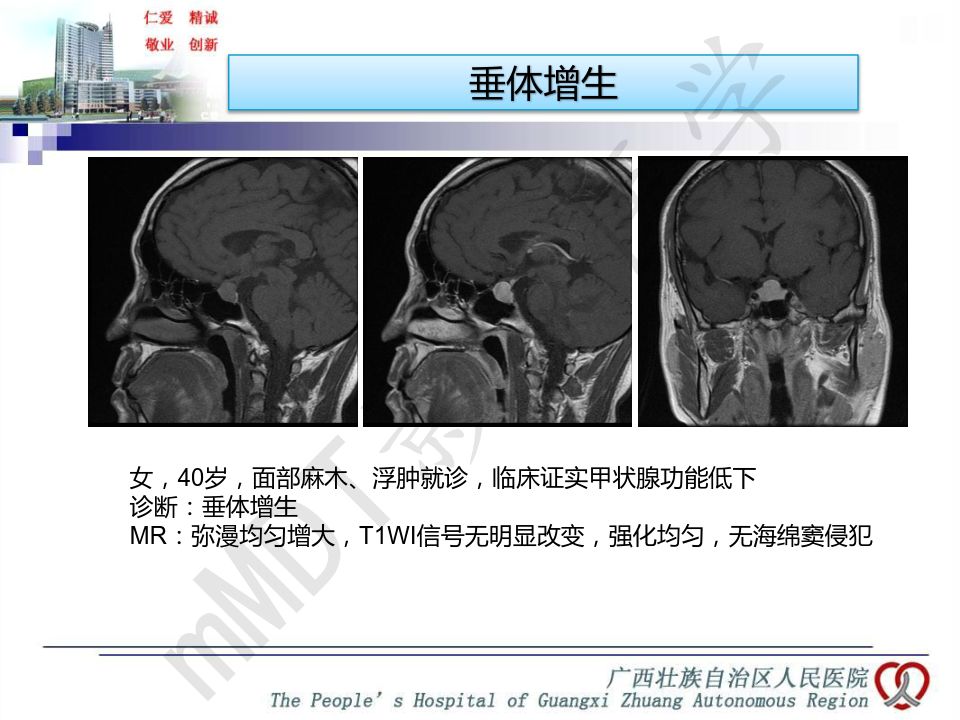 【PPT】垂体非肿瘤性病变MR诊断