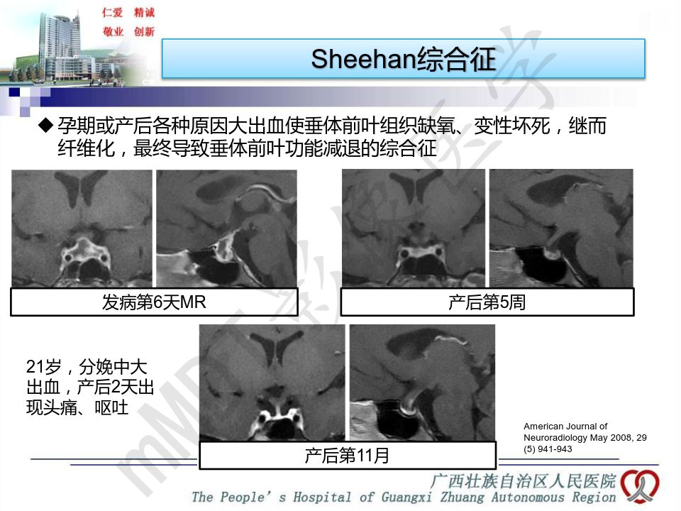 【PPT】垂体非肿瘤性病变MR诊断