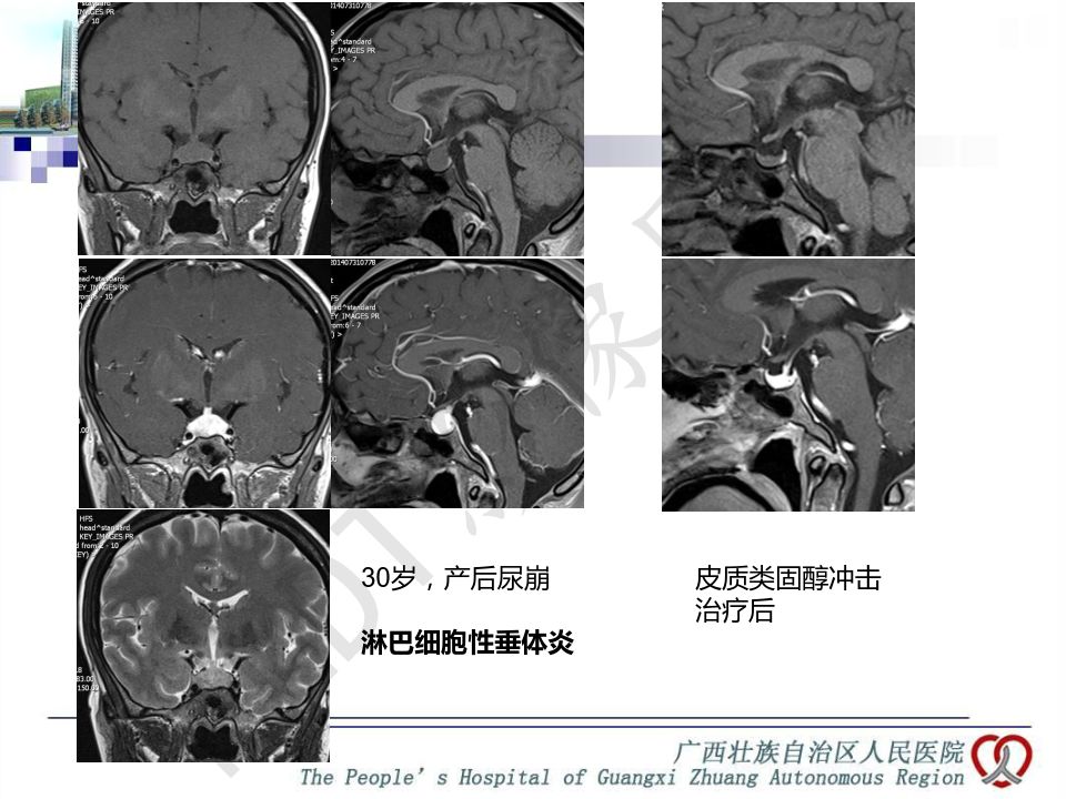 【PPT】垂体非肿瘤性病变MR诊断