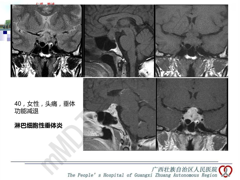 【PPT】垂体非肿瘤性病变MR诊断
