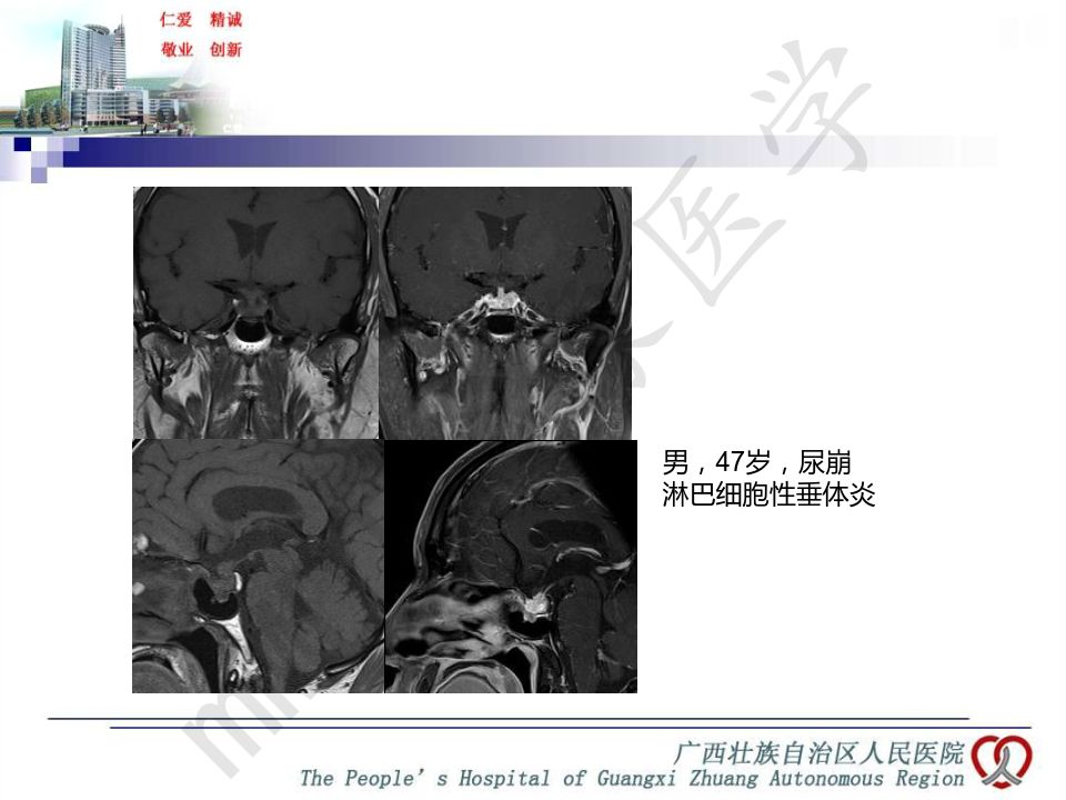 【PPT】垂体非肿瘤性病变MR诊断