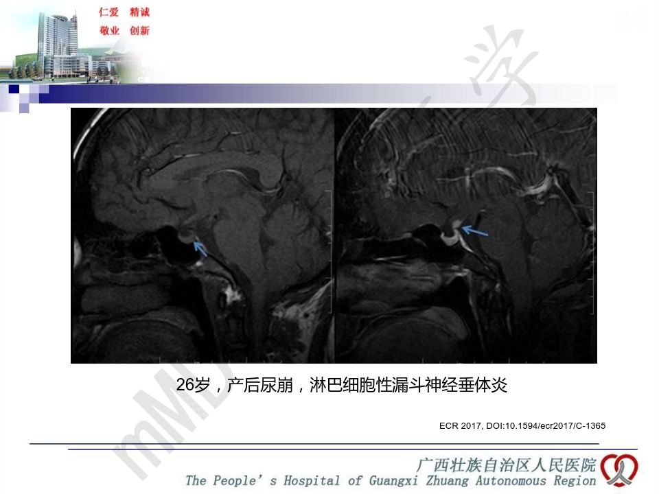 【PPT】垂体非肿瘤性病变MR诊断
