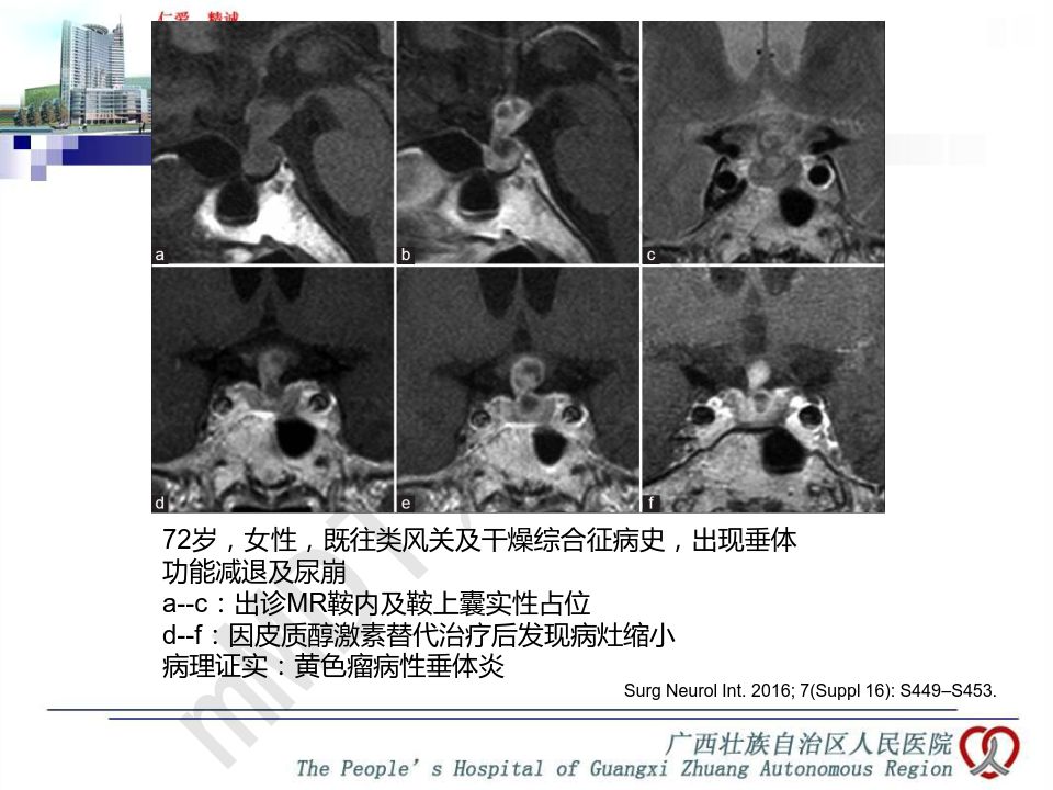 【PPT】垂体非肿瘤性病变MR诊断