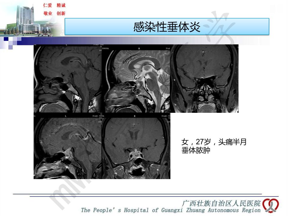 【PPT】垂体非肿瘤性病变MR诊断