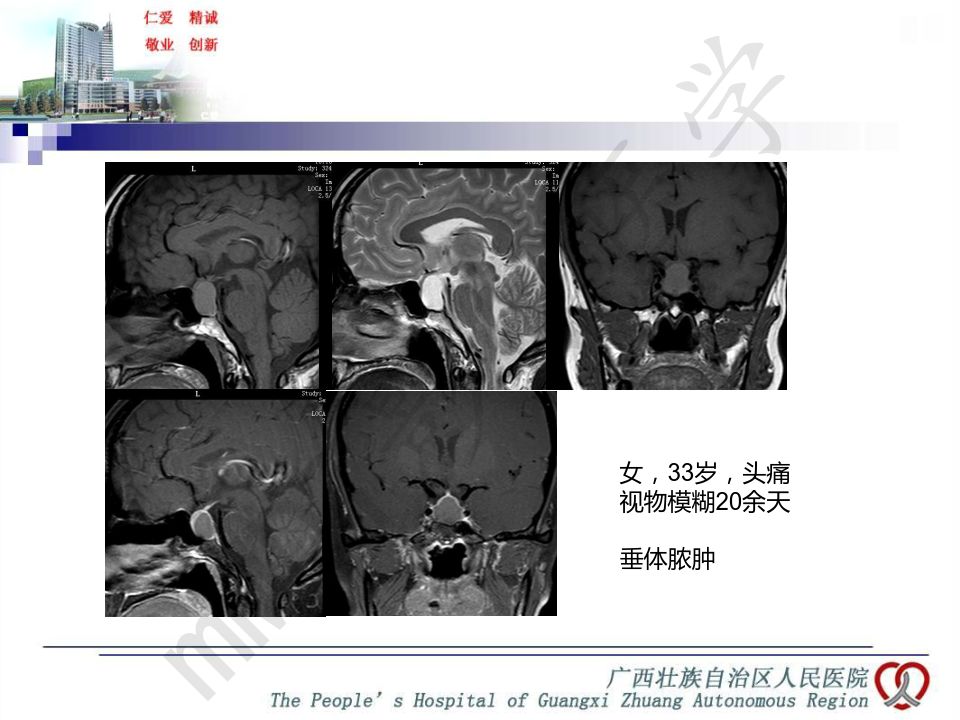 【PPT】垂体非肿瘤性病变MR诊断