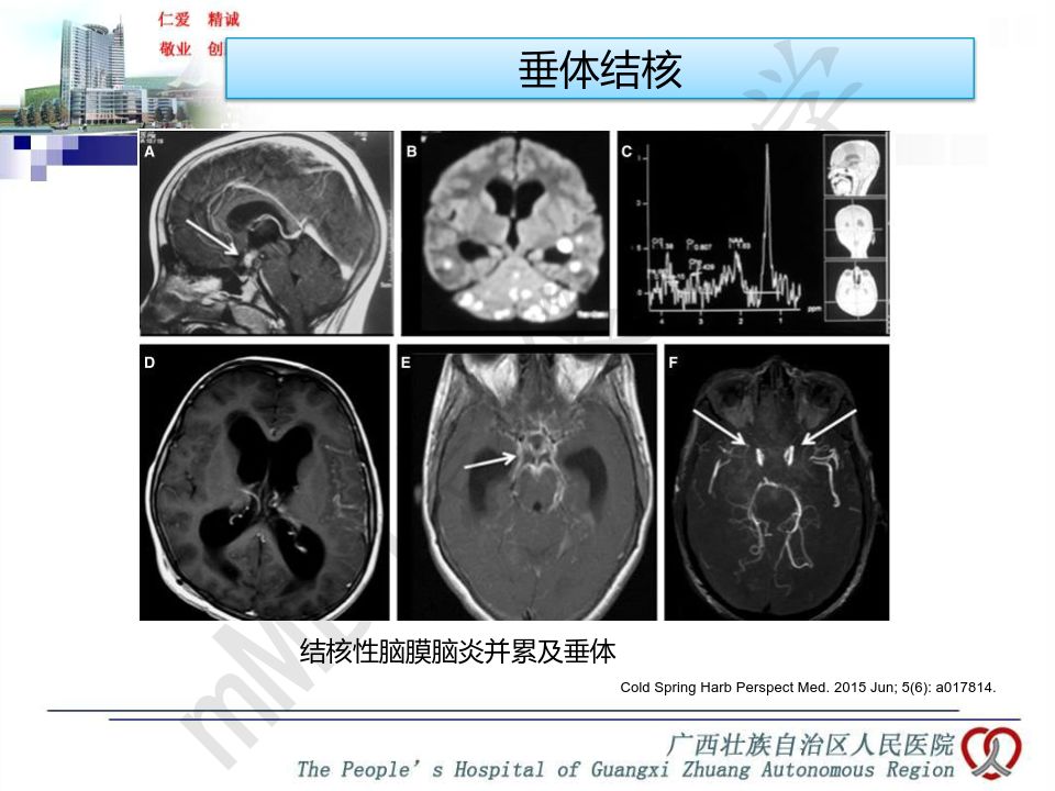 【PPT】垂体非肿瘤性病变MR诊断