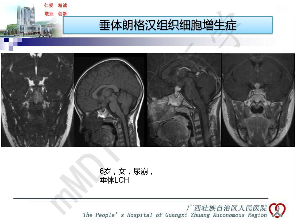 【PPT】垂体非肿瘤性病变MR诊断