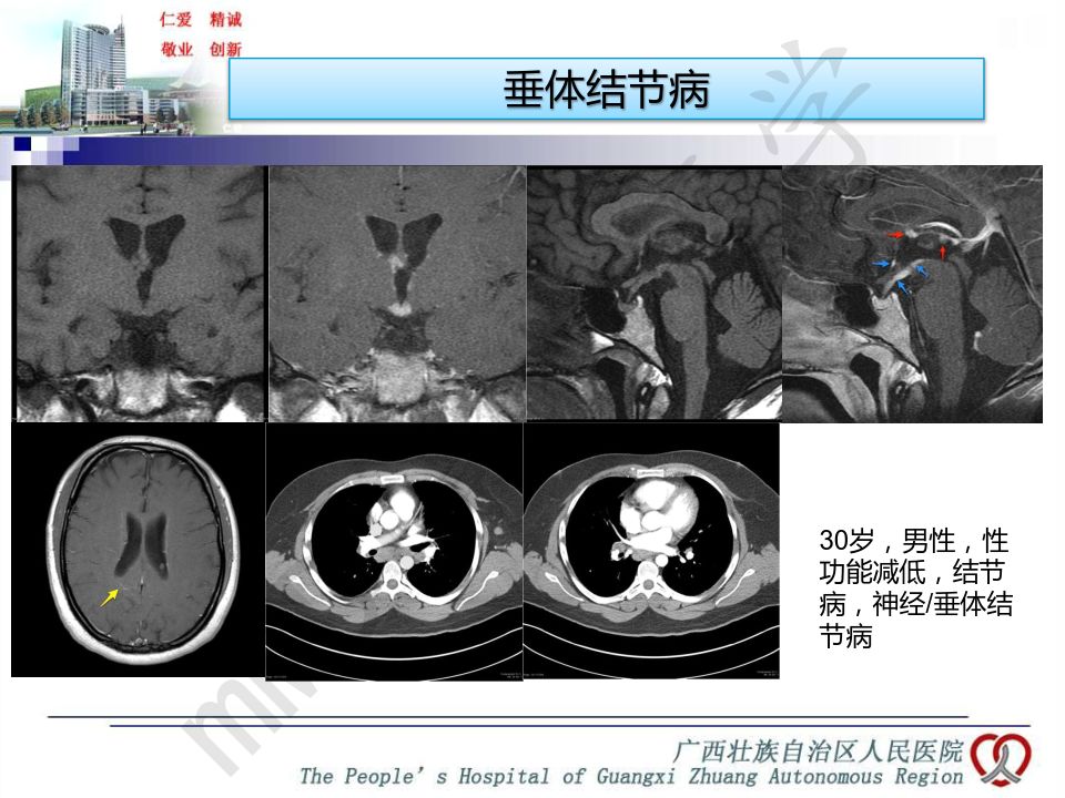 【PPT】垂体非肿瘤性病变MR诊断