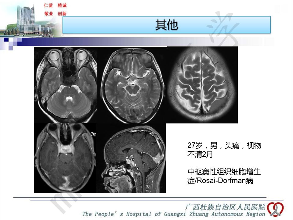 【PPT】垂体非肿瘤性病变MR诊断