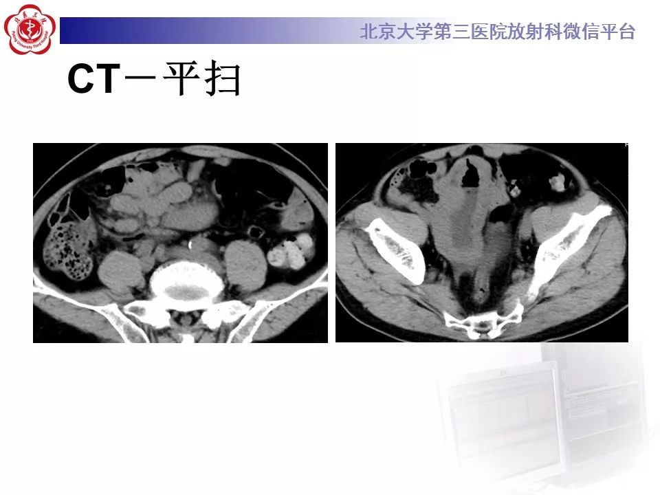 【病例】小肠原发性淋巴瘤1例CT影像表现