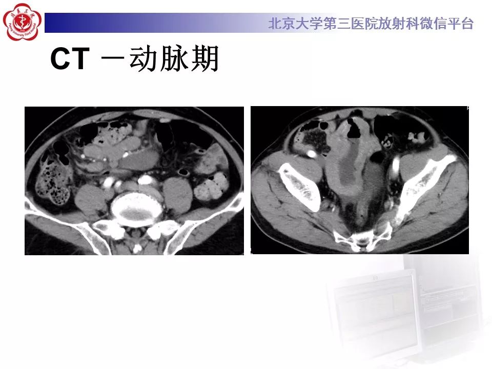 【病例】小肠原发性淋巴瘤1例CT影像表现