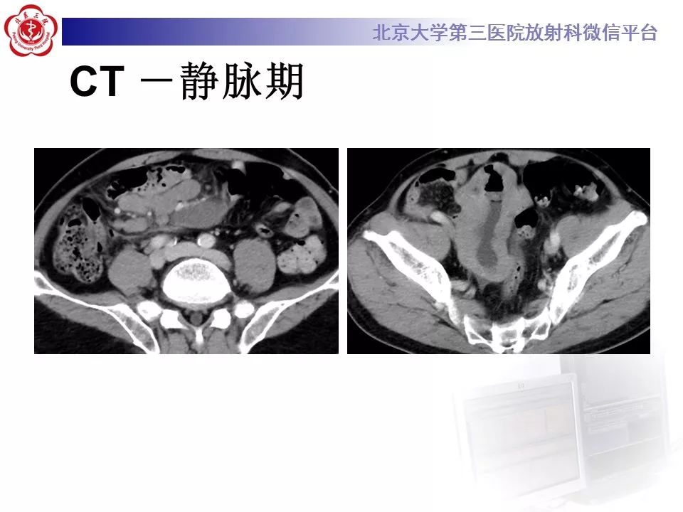 【病例】小肠原发性淋巴瘤1例CT影像表现