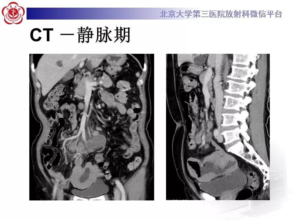 【病例】小肠原发性淋巴瘤1例CT影像表现