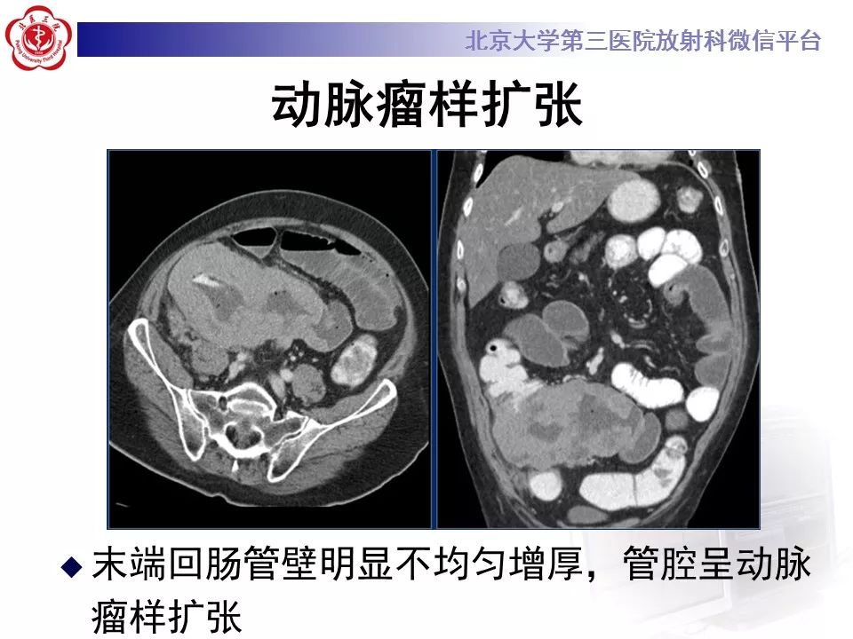 【病例】小肠原发性淋巴瘤1例CT影像表现