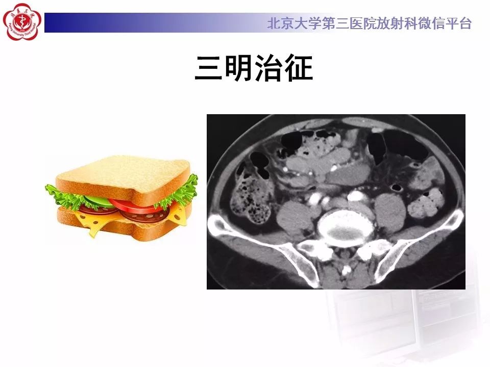【病例】小肠原发性淋巴瘤1例CT影像表现