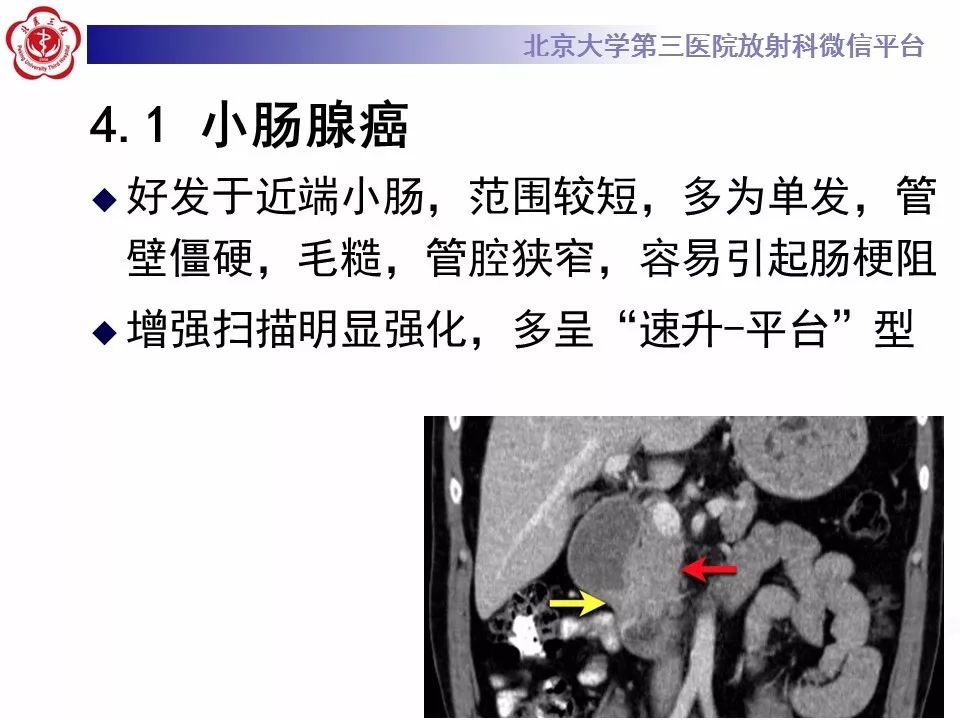 【病例】小肠原发性淋巴瘤1例CT影像表现