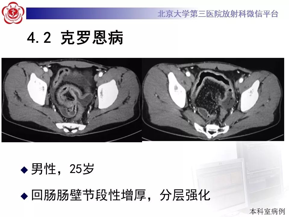 【病例】小肠原发性淋巴瘤1例CT影像表现
