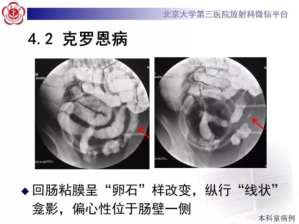 【病例】小肠原发性淋巴瘤1例CT影像表现