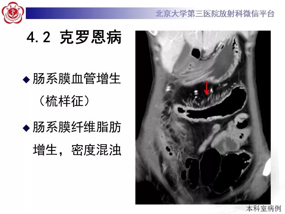 【病例】小肠原发性淋巴瘤1例CT影像表现