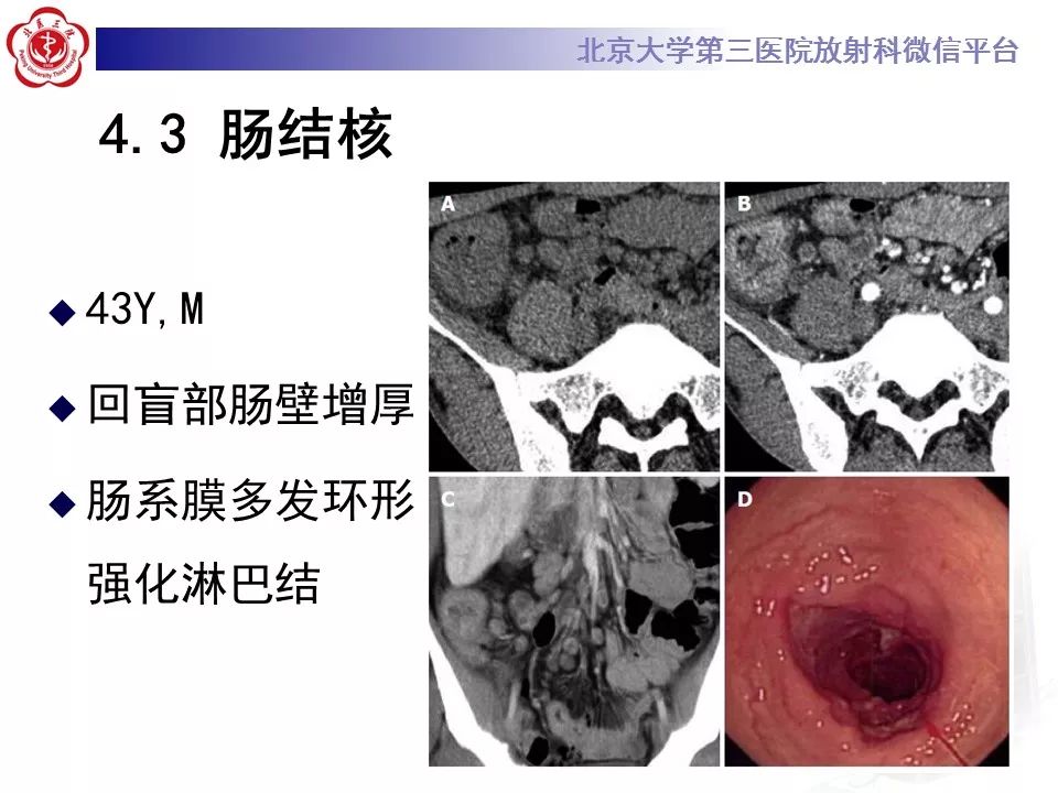 【病例】小肠原发性淋巴瘤1例CT影像表现