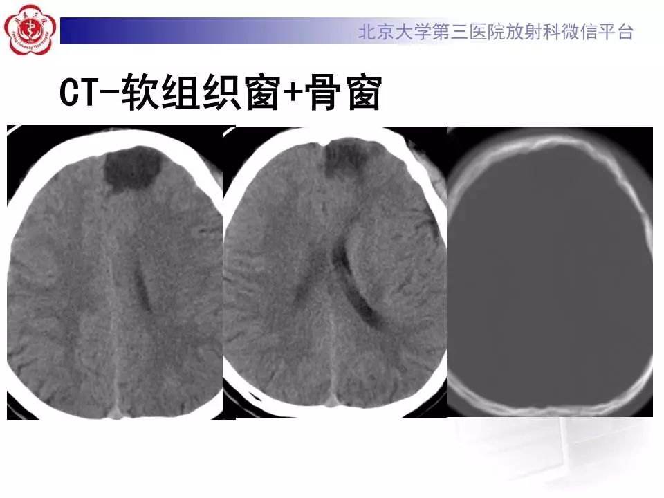 【病例】胚胎发育不良性神经上皮瘤1例