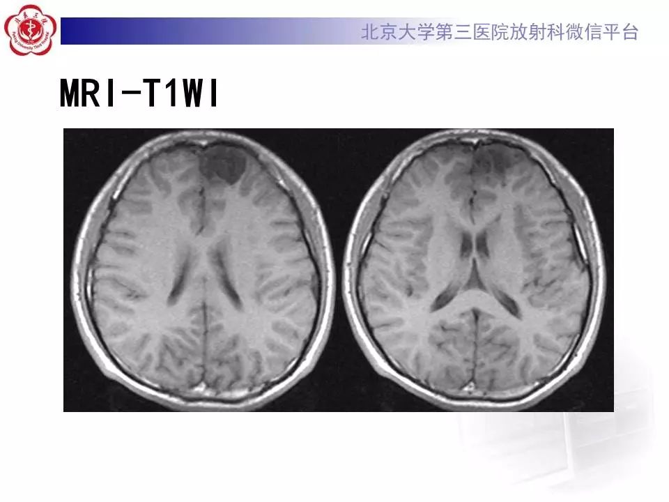 【病例】胚胎发育不良性神经上皮瘤1例