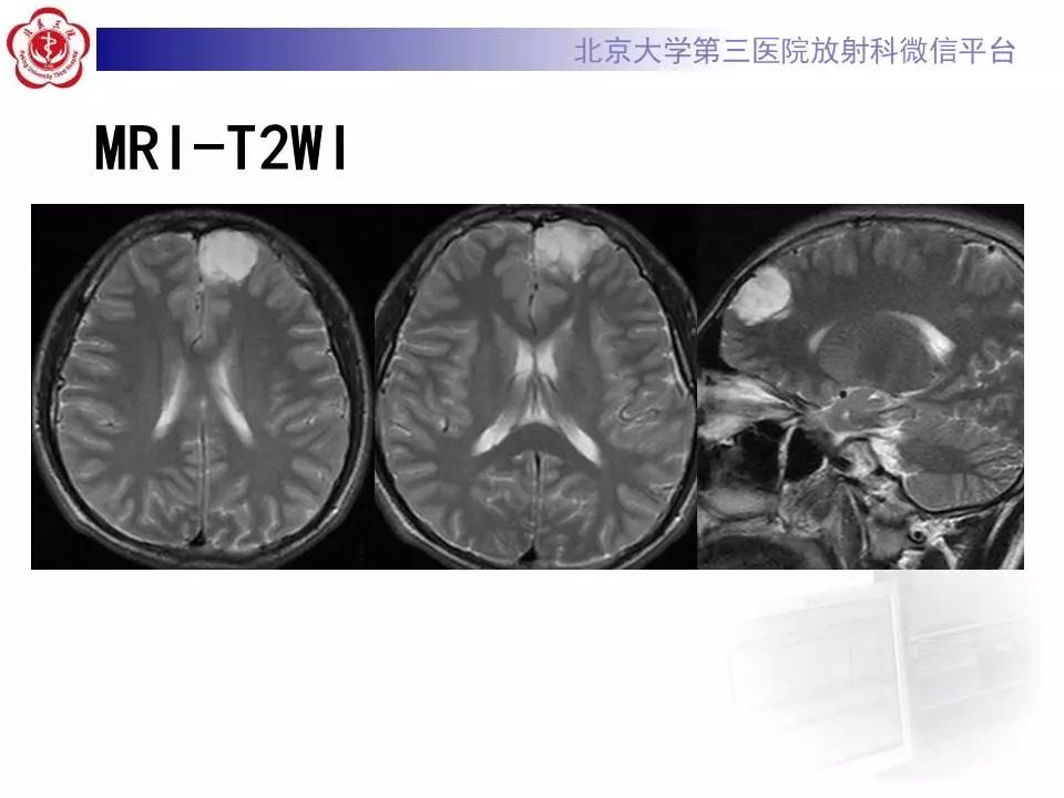 【病例】胚胎发育不良性神经上皮瘤1例