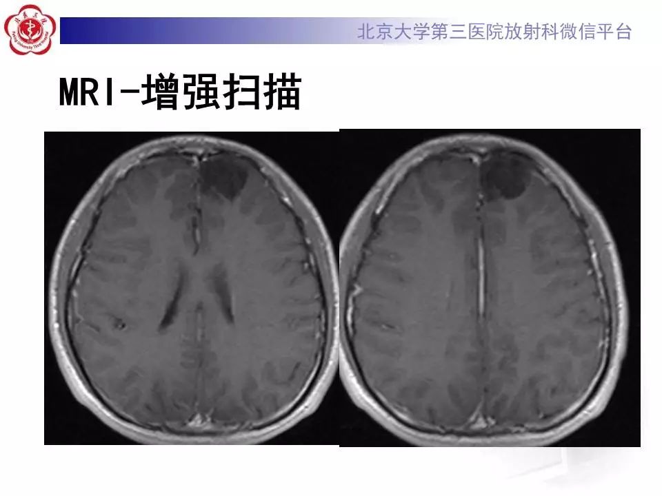 【病例】胚胎发育不良性神经上皮瘤1例