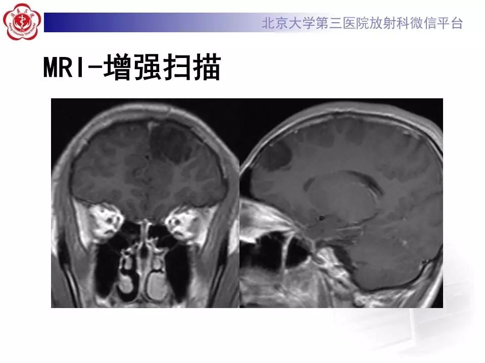 【病例】胚胎发育不良性神经上皮瘤1例