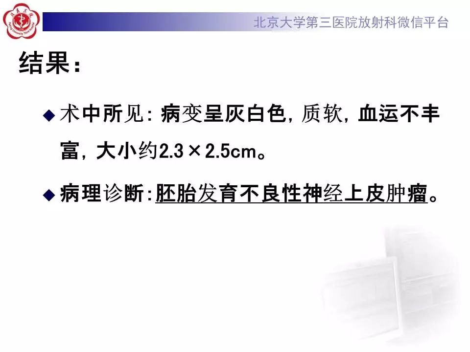 【病例】胚胎发育不良性神经上皮瘤1例