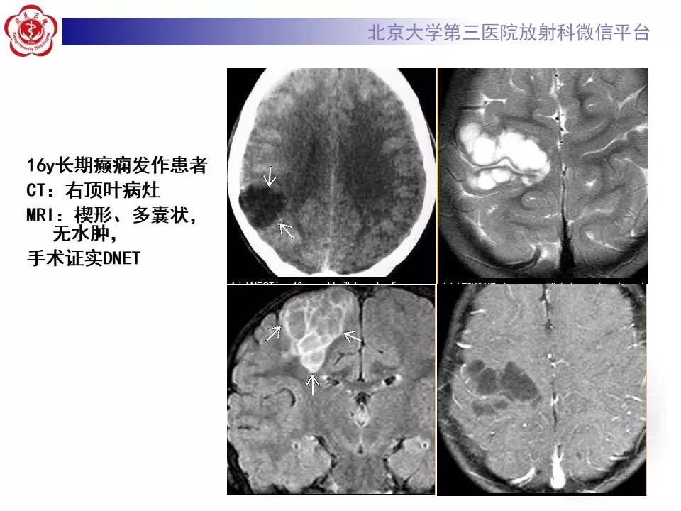 【病例】胚胎发育不良性神经上皮瘤1例