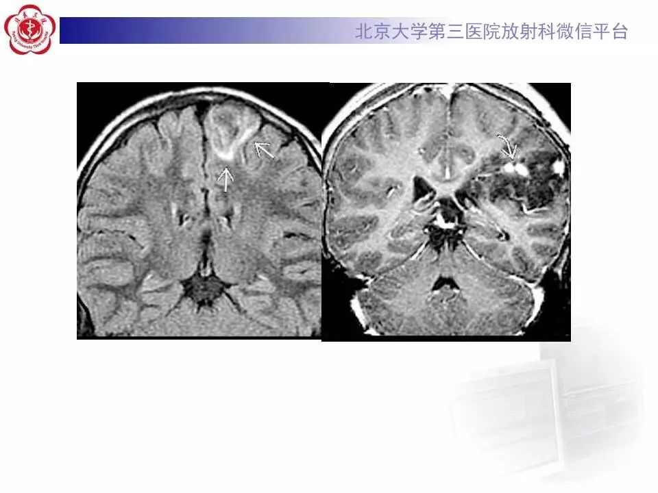 【病例】胚胎发育不良性神经上皮瘤1例