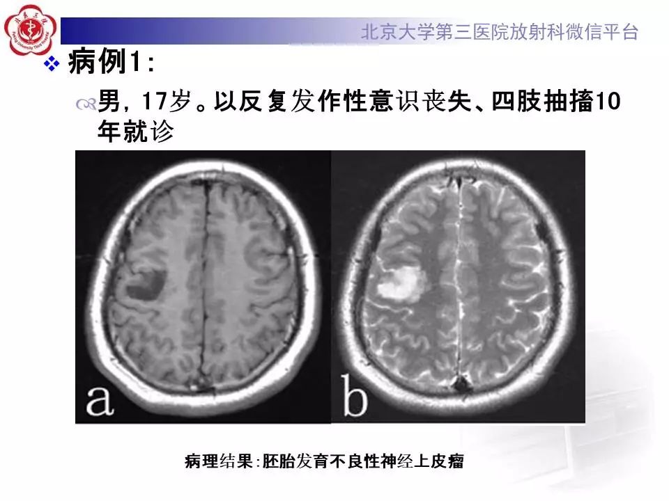 【病例】胚胎发育不良性神经上皮瘤1例