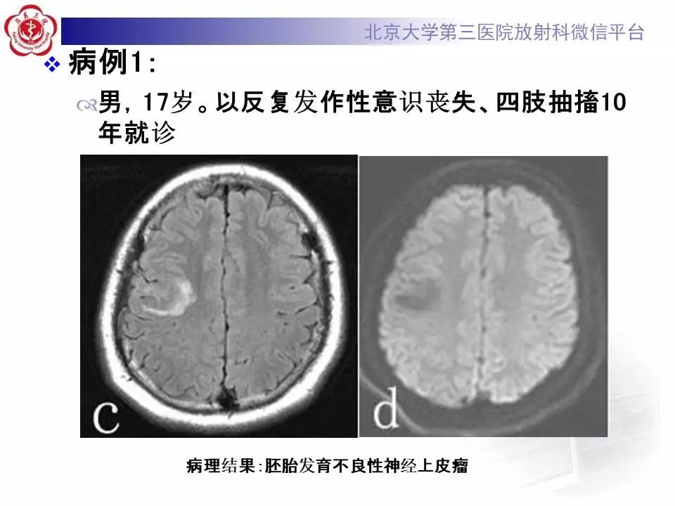 【病例】胚胎发育不良性神经上皮瘤1例