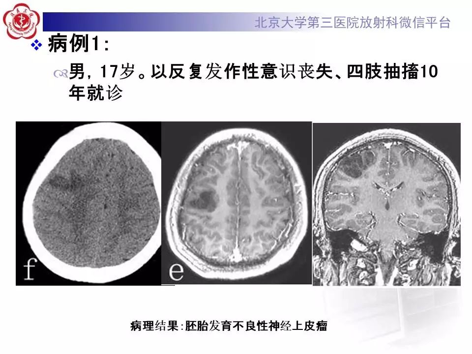 【病例】胚胎发育不良性神经上皮瘤1例