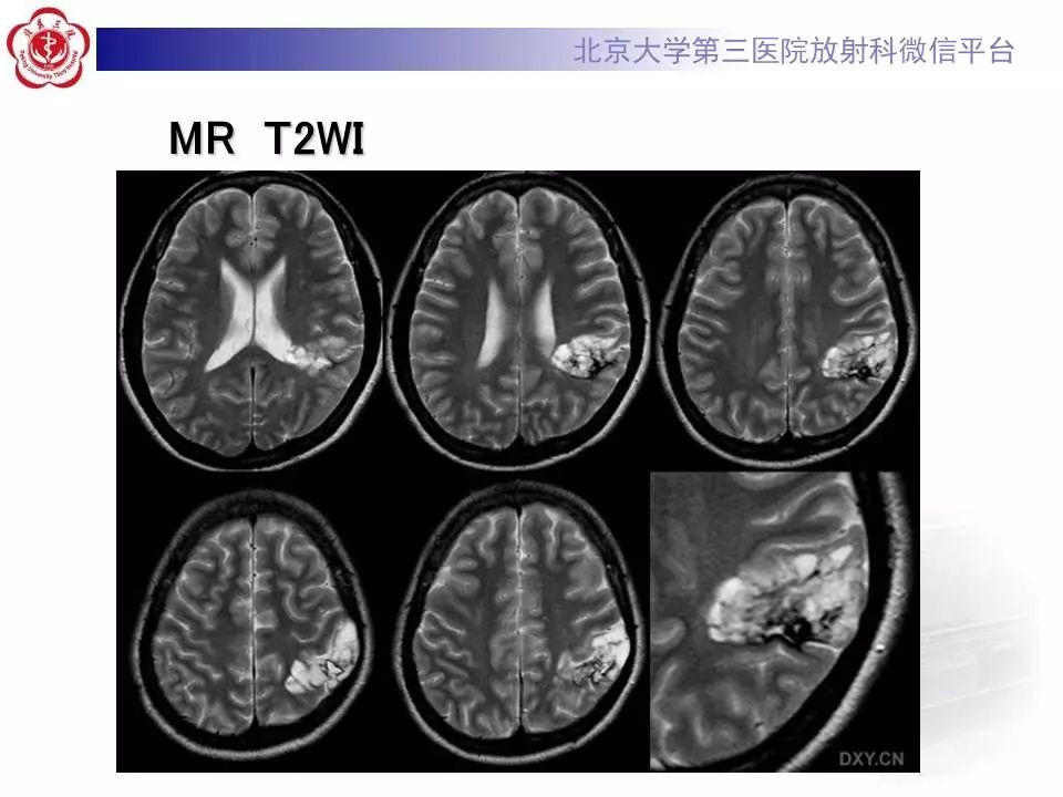 【病例】胚胎发育不良性神经上皮瘤1例