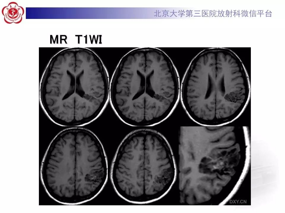 【病例】胚胎发育不良性神经上皮瘤1例