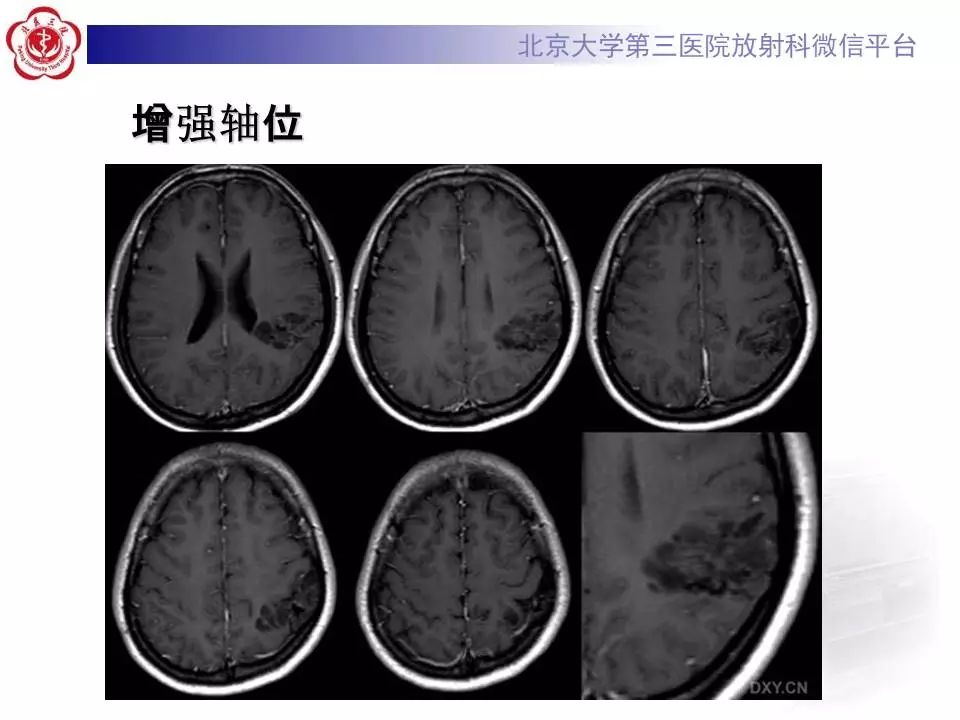 【病例】胚胎发育不良性神经上皮瘤1例