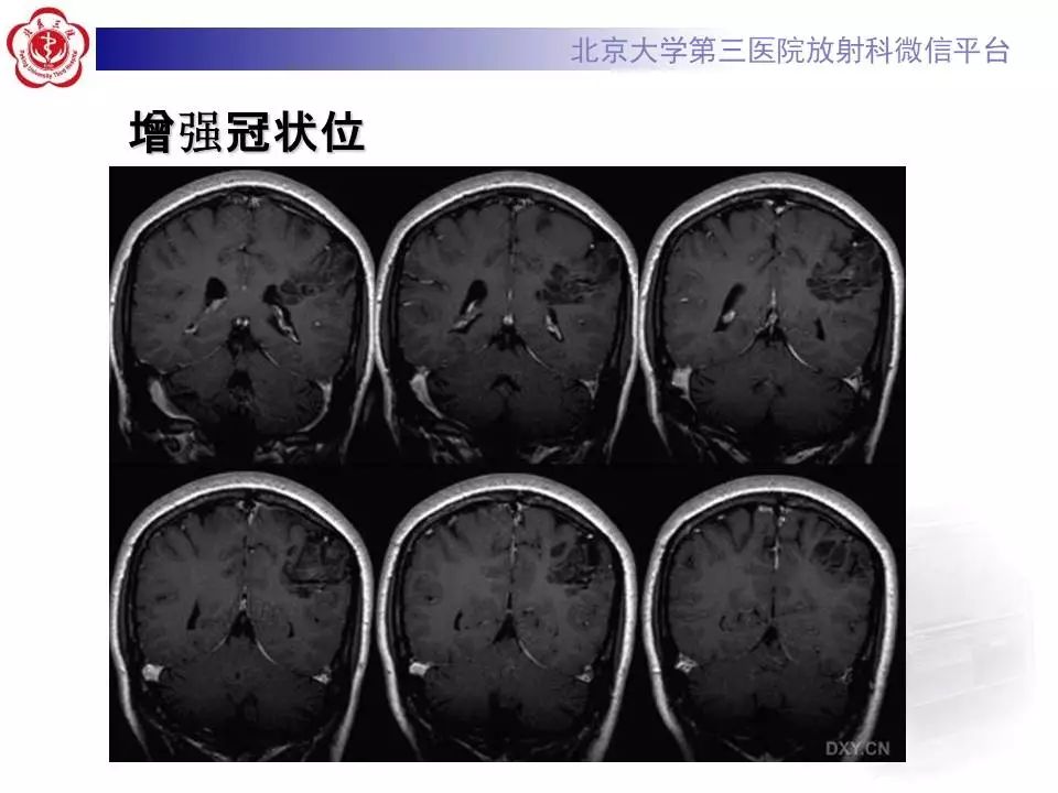 【病例】胚胎发育不良性神经上皮瘤1例