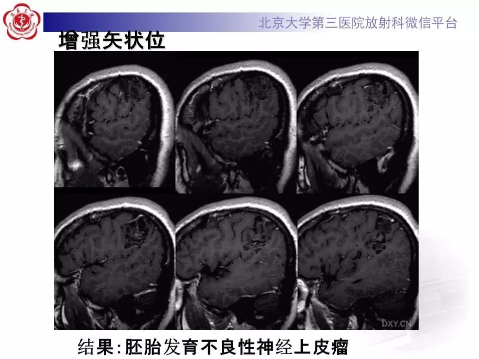 【病例】胚胎发育不良性神经上皮瘤1例