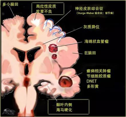 Transmantle 征可用来诊断癫痫灶 Transmantle 征可用来诊断癫痫灶