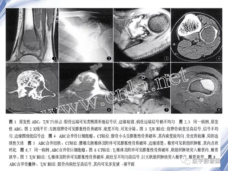 【PPT】动脉瘤样骨囊肿的影像学分析