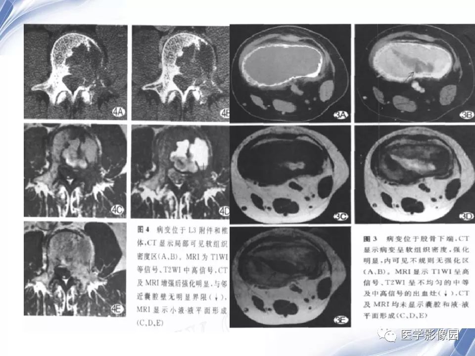 【PPT】动脉瘤样骨囊肿的影像学分析