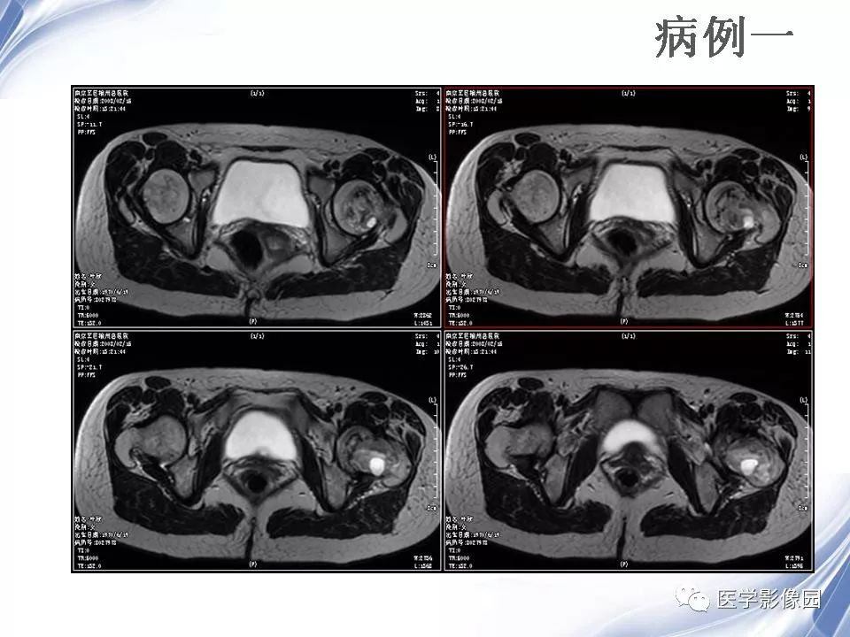 【PPT】动脉瘤样骨囊肿的影像学分析
