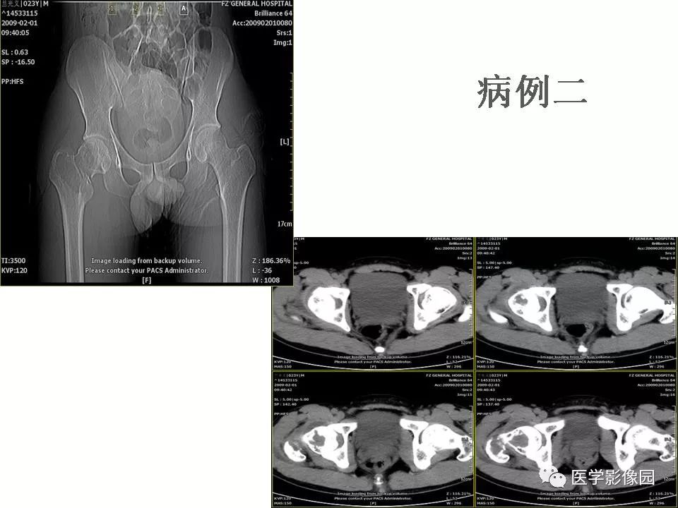 【PPT】动脉瘤样骨囊肿的影像学分析